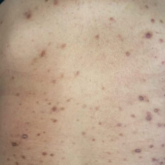 Curso online de Prurigo crónico (Extranjeros)